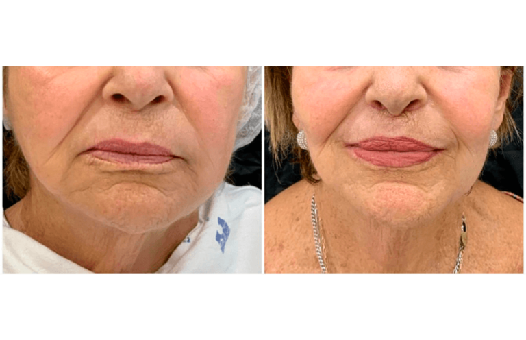 Lip Lift Procedimento Para Os L Bios Canoas