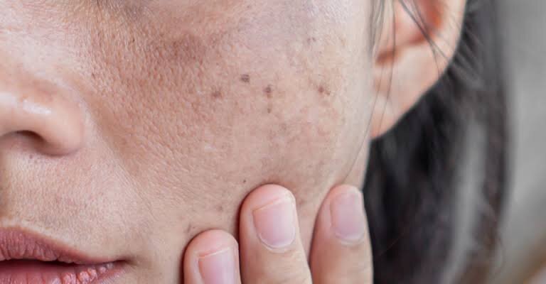 Quais são os tipos de manchas do rosto e como tirá-las?